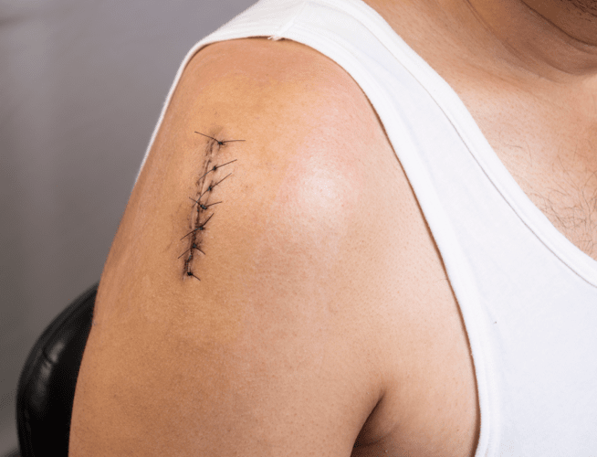 A shoulder wound that has received medical attention.