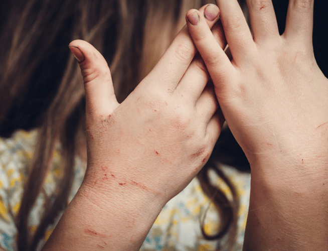 A child's hands with scratch marks from a possibly rabid animal.