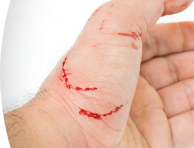 Human hand with scratch and bite wounds from an animal that may have rabies.