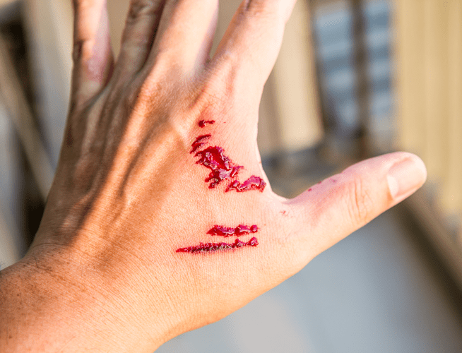 Closeup of a human hand with bleeding wounds inflicted by an animal that may have rabies