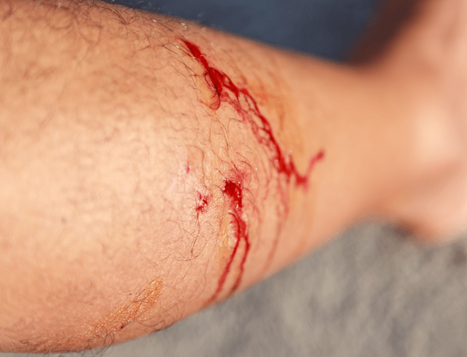 Close up view of a man’s arm with bleeding puncture bite wounds from an animal suspected of having rabies