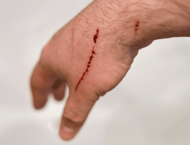 Man’s hand with bleeding scratch wounds from an animal suspected of having rabies